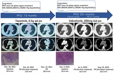 Case report: The effect of second-line vebreltinib treatment on a patient with advanced NSCLC harboring the MET exon 14 skipping mutation after tepotinib treatment